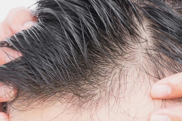 Unshaved Hair Transplant